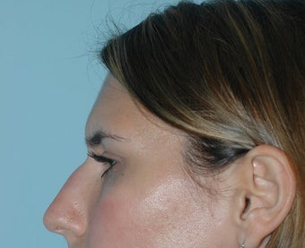 Rhinoplasty before 118337