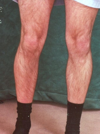 Men's Calf Augmentation 519062