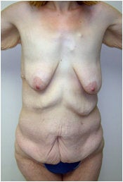 Body Lift before 205414