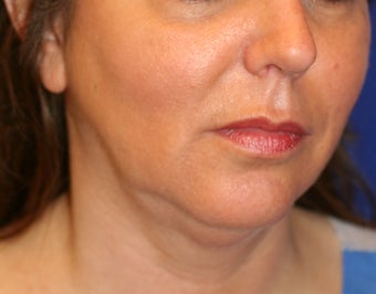 Neck Liposuction before 531701