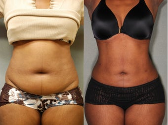44 Year old Female SmartLipo before 631188
