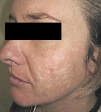 Laser Acne Scar Removal before 82946