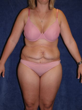 Tummy Tuck with Liposuction before 411003