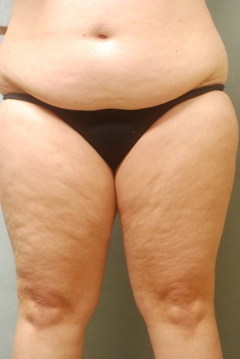 SmartLipo Complete Wrap around 346597