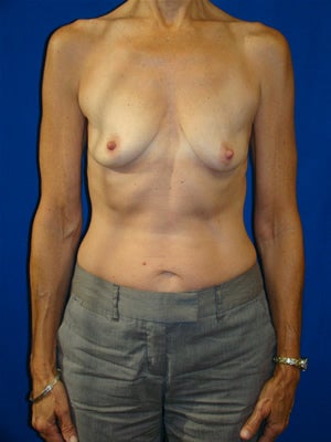 Breast Augmentation Surgery before 151616