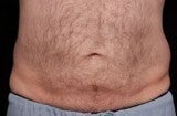 CoolSculpting after 559918