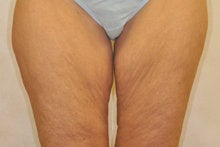 Medial (Inner) Thigh Lift before 341015
