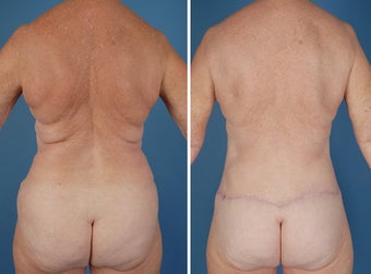 Flank Excision, Abdominoplasty Scar Revision, Liposuction of the Back after 303691