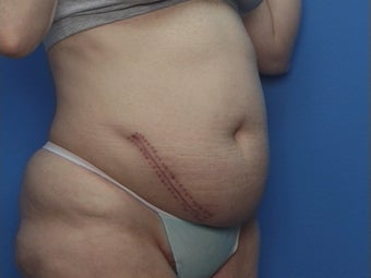 Abdominoplasty before 134584