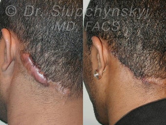 Keloid Removal before 548937