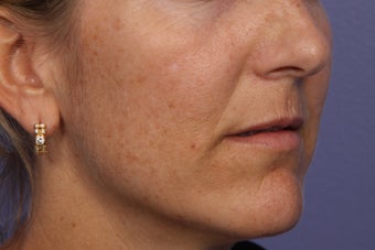 Fraxel Dual Laser before 309242