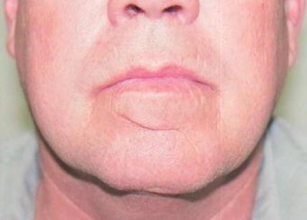Scar Revision before 236057