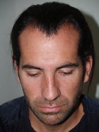 Hair Transplant and Rhinoplasty before 218207