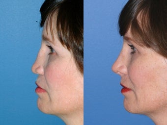 Revision rhinoplasty after 334236