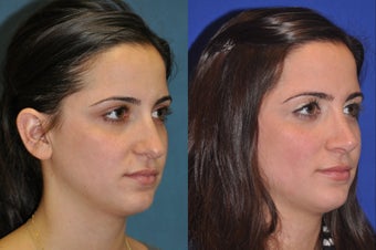 Rhinoplasty before 256041