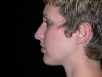 Rhinoplasty and Chin Implants after 257839