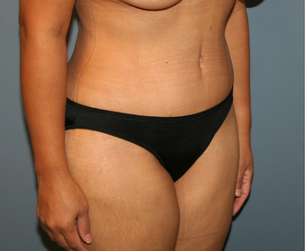 tummy tuck 527241