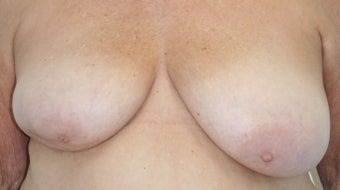Breast Reconstruction before 517501