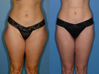Liposuction - Hips and Thighs before 131866