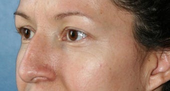 Rhinoplasty Gallery before 129737