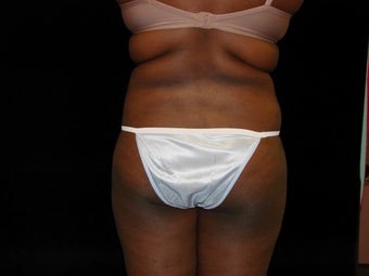 Liposuction of Abdomen, Waist, Flanks and Dorsal Roll before 203520