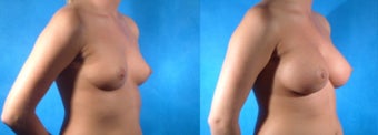 Breast Implants before 223395