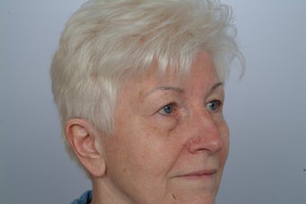 Upper and lower Blepharoplasty before 321991