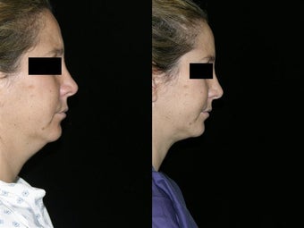 Neck Lipectomy before 143596