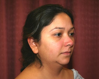 liposuction of neck & jaw line for women in Los Angeles before 583586