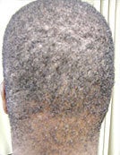 Surgical Treatment of Acne Keloidalis Nuchae after 196059