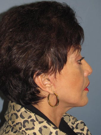 Neck Lift, Platysmaplasty 634750