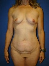 Tummy Tuck (Abdominoplasty),Breast Augmentation, Mommy Makeover, Liposuction before 404209