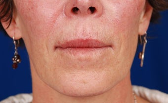 Nasolabial fold correction after 258481