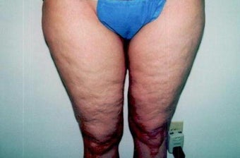 Medial Thigh Lift after 247666