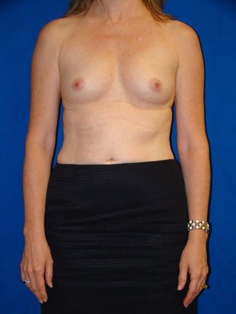 Breast Augmentation before 76684