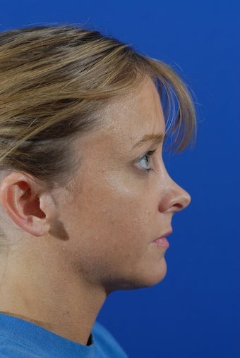 Revision Rhinoplasty before 274191