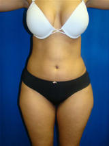 Liposuction before 119486