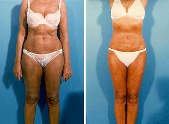 Liposuction before 636227