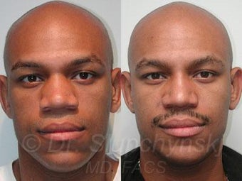 African American Rhinoplasty before 374019