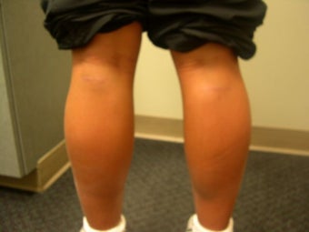 Calf Implants after 259000