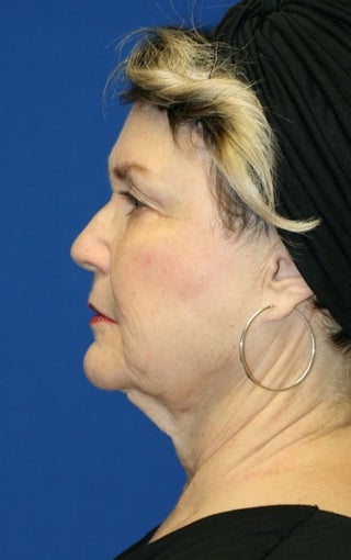 1 month post op: Facelift, Necklift, Browlift, Fat Transfer, Upper Bleph 456304