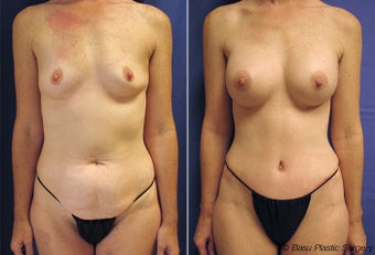 Mommy makeover (tummy tuck and breast augmentation) before 146926