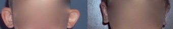 Otoplasty before 78403
