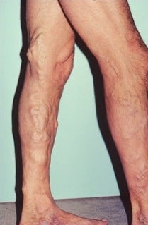 Phlebectomy Leg Vein Removal before 370430