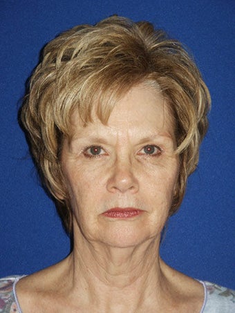 Facelift, Anterior Hairline Browlift, Upper and Lower Blepharoplasty, Perioral Dermabrasion before 248901