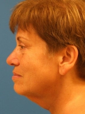 Lower Facelift and Necklift with Platysmaplasty before 242881