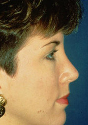 Rhinoplasty after 319080