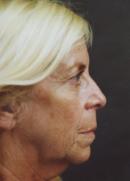 Facelift before 335839