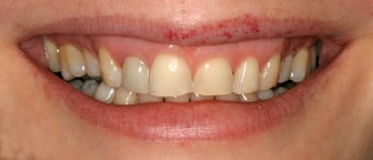Dental implants, all porcelain restorations, gum re-contouring before 503152
