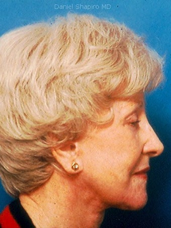 Facelift, Endoscopic Browlift, Upper and Lower Blepharoplasty after 248895